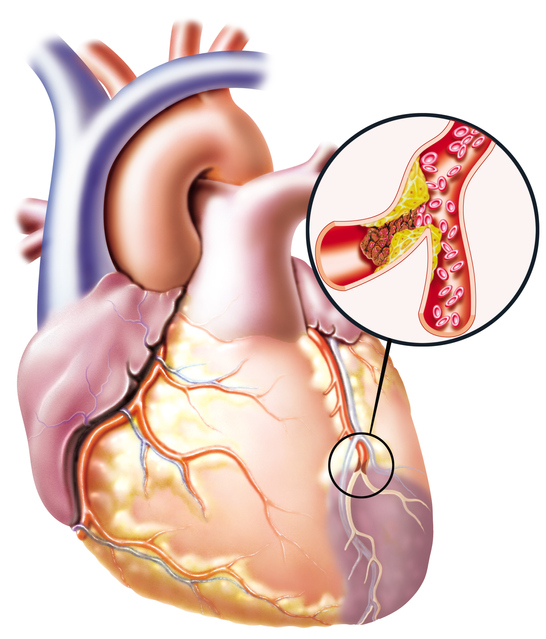 Image du cœur présentant une altération de la circulation sanguine et l'obstruction d'un vaisseau sanguin.